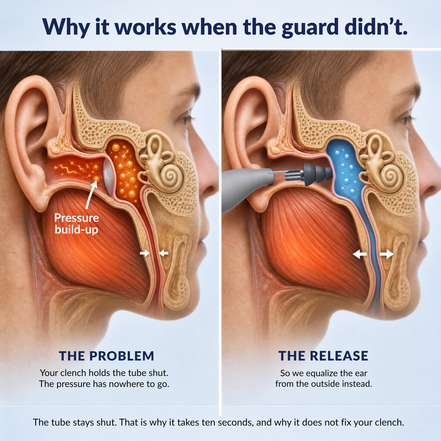 Arcelux Ear Fullness Release Tool