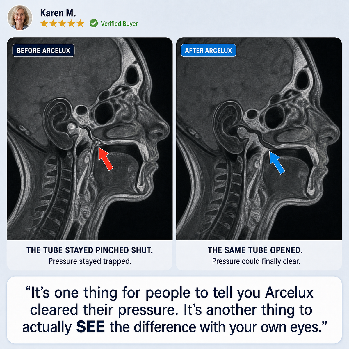 Arcelux™ Ear Pressure Equalization System